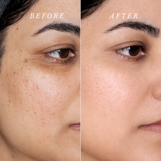 Before and after comparison of a person's face with visible skin improvement.